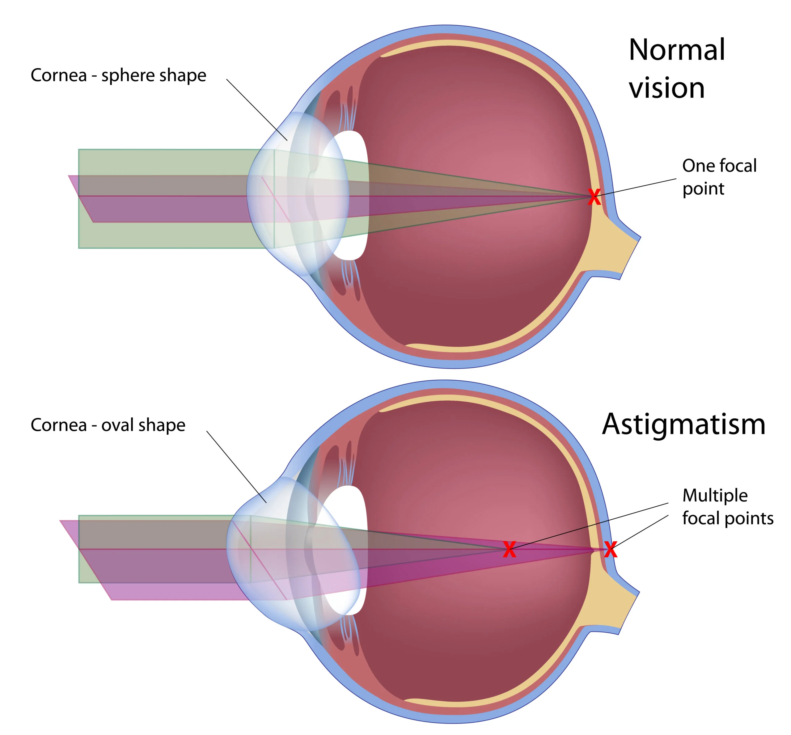 Astigmatism Can Cause Lights To Appear Distorted, Do You Suffer From This?